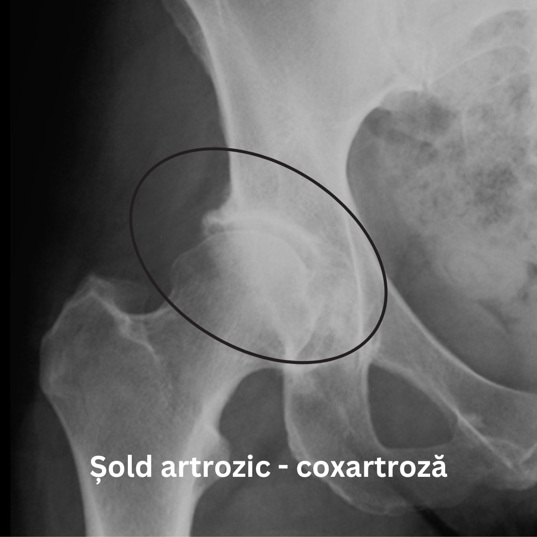 coxartroza