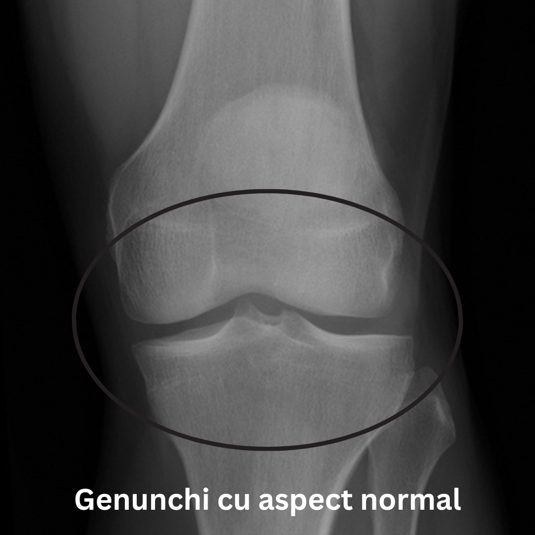 radiografie genunchi