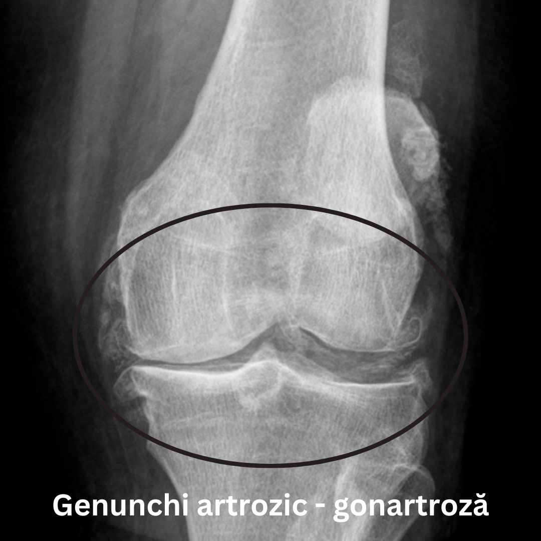 radiografie gonartroza